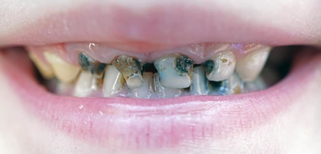 Decaying Children's Teeth